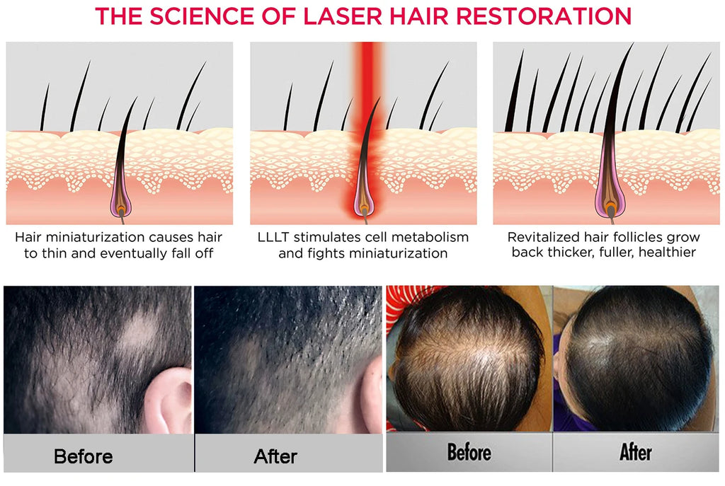black diode laser LLLT low leve laser 650nm hair growth products