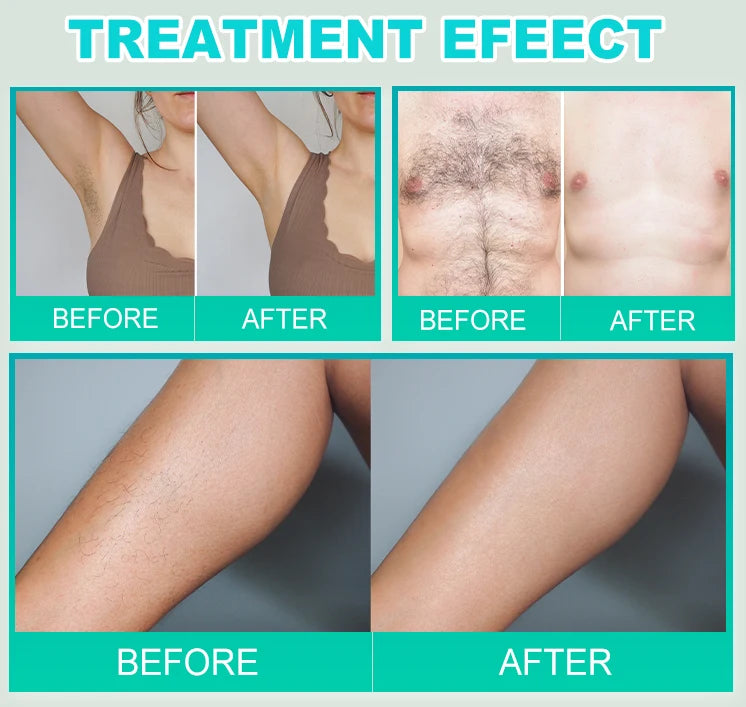 2025 Portable Electrolysis Epilators Removal Device Painless Electrolysis Machine Electric Needle Hair Removal for Men